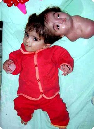 conjoined_head2.jpg