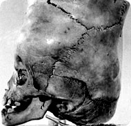 /x/images2005/conjoined_head3.jpg