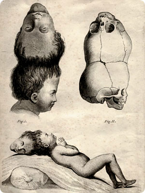 conjoined_head5.jpg