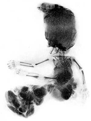 conjoined_head6.jpg