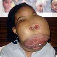 face_tumor1.jpg