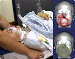 face_transplant_french2.jpg
