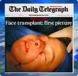 face_transplant_french4.jpg