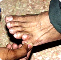 finger_lost2.jpg