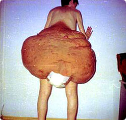 gigantic_tumor1.jpg