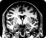 hypothalamic_hamartoma.jpg