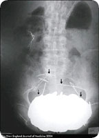 stomach_xray.jpg
