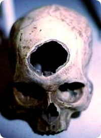 trepanation5.jpg