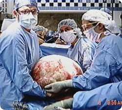 tumor_30kg2.jpg
