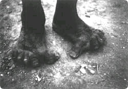 yeti_deformity.jpg